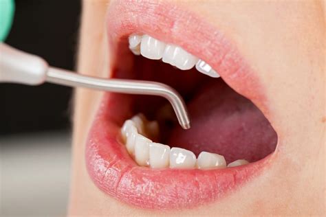 Black tartar: causes and how to eliminate it - Adeslas Dental