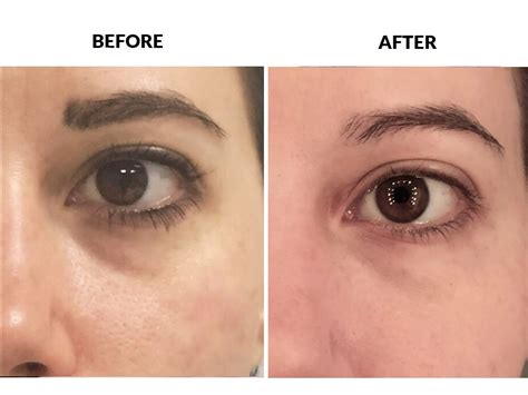 Best Eye Fillers Treatment in South Delhi | DerMediCo