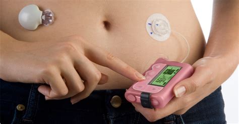 Myth Vs Reality: Insulin Pumps And Continuous Glucose Monitors | The ...