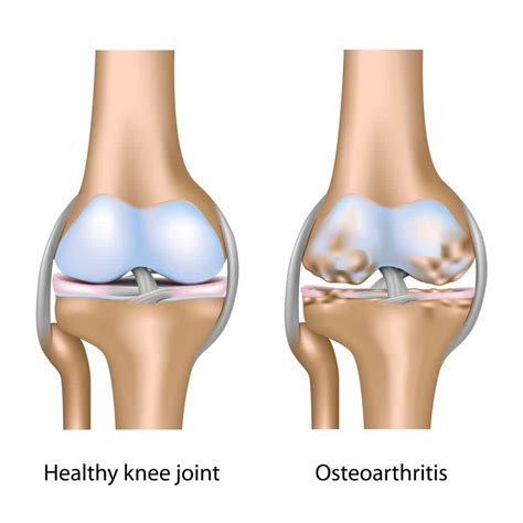 Degenerative Joint Disease Treatments – Howard J. Luks, MD