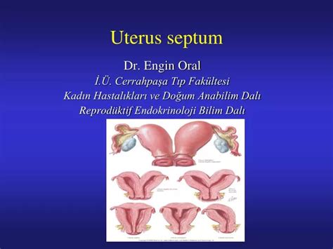 PPT - Uterus septum PowerPoint Presentation, free download - ID:1972943