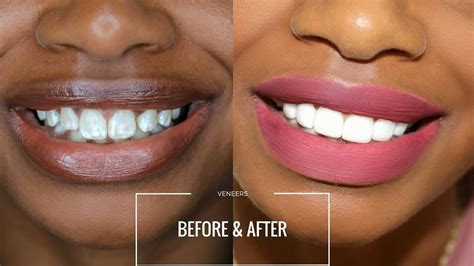 Veneers Before And After Pictures | Before And After