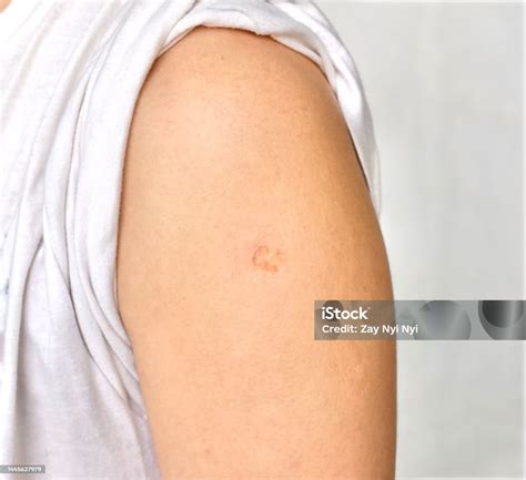 Bcg Or Tb Vaccine Scar Mark At The Arm Of Asian Man Stock Photo - Download Image Now - iStock