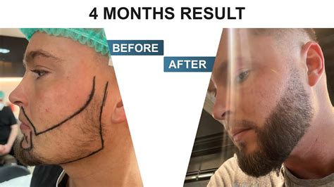 Beard Transplant in Turkey - Result in 4 month (Hermest) - YouTube