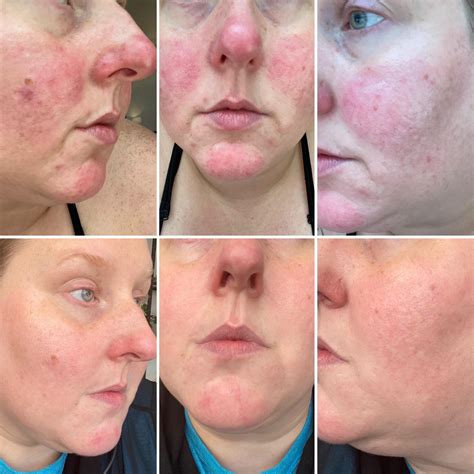 Results from 2 Vbeam Sessions & Azelaic Acid 15% Regimen : r/Rosacea