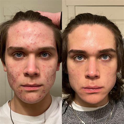 Thought I’d post an update for the first time in a while: 10 months on accutane! This drug has ...