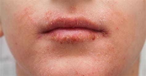 How To Reduce Redness Around Lips - Considerationhire Doralutz