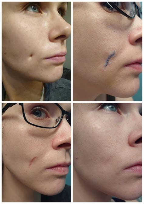 Dimple Piercing Scar Revision Surgery (6 months PO) [Before&After] : r/SkincareAddiction