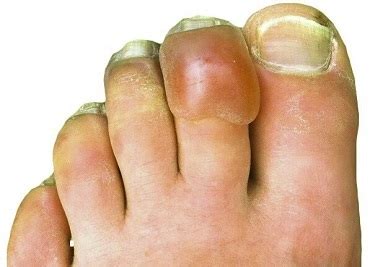 Blisters On Feet & Toes: Causes & Treatment - Foot Pain Explored (2023)