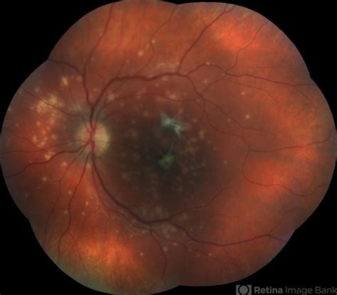 Punctate Inner Choroidopathy: vision loss causing disease