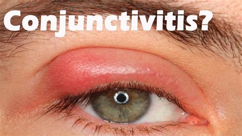 Understanding the Three Kinds of Conjunctivitis: Causes and Symptoms - Pilates & Yoga Fitness