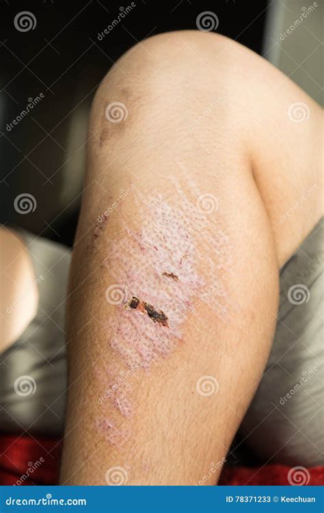 Injured Knee with Scar from Abrasion Healing Stock Image - Image of knee, hand: 78371233