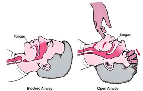 Head tilt chin lift maneuver & jaw thrust maneuver