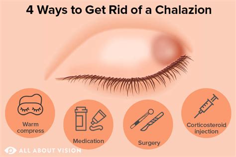 What Is A Chalazion (Bump On Eyelid)?, 59% OFF