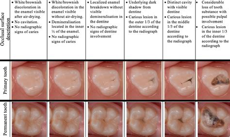 Carious lesion management in children and adolescents by Australian dentists - Keys - 2019 ...