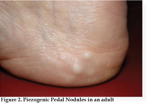 Figure 2 from PIEZOGENIC PEDAL NODULES OF YOUNG CHILDREN AND THEIR ...