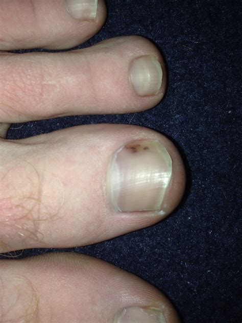 What Causes Black Spots On Fingernails - Design Talk