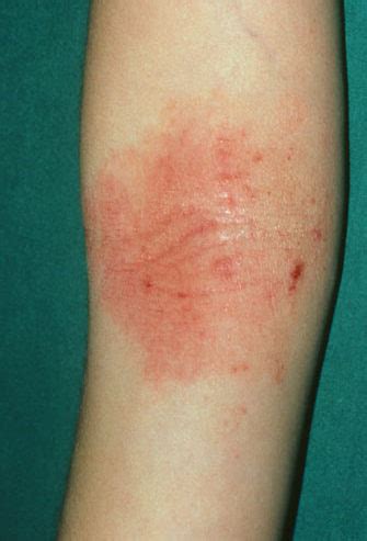 Atopic Dermatitis / Eczema - Lowe Dermatology | Stop the itch today