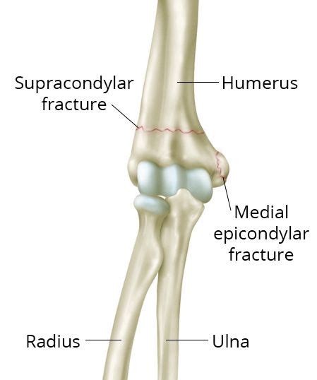 Singapore Elbow Fracture Clinic | Bone Clinic & Neurosurgeon