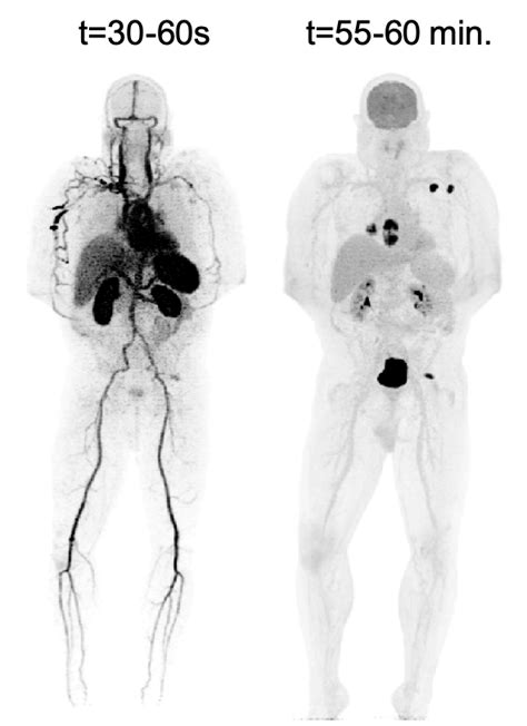 2019/12: First total-body dynamic PET scan of a cancer patient completed – Wang Lab – PET ...