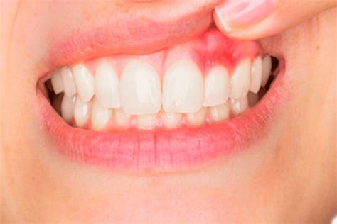 5 Signs of Gum Disease - Advanced Solutions Family Dental