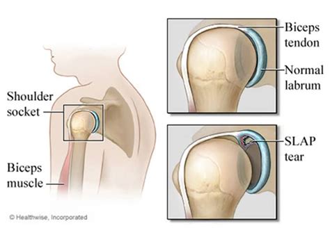 SLAP Tear - Krupa Orthopaedic Hospital