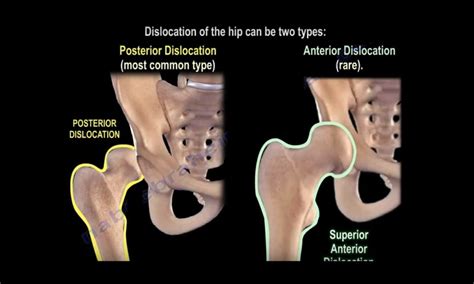 Hip dislocations and its Implications — OrthopaedicPrinciples.com