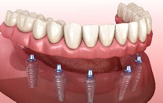 Snap-in Dentures in Glendale AZ - Implant Supported Dentures