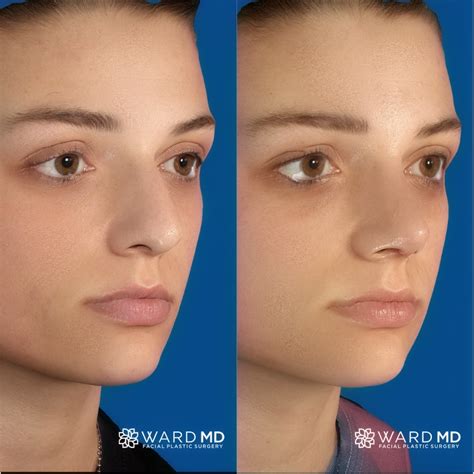 Ward MD Rhinoplasty Before & After