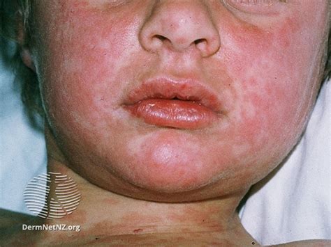 Measles Baby