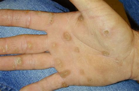 Keratoderma Blennorrhagicum