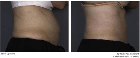 Liposonix NYC Before and After Photos