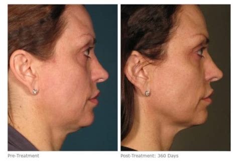 How To Get Rid Of Turkey Neck | Silhouette Soft Thread Lift, Ultherapy Turkey Neck London, Bucks