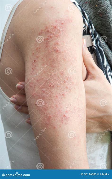 Ill Allergic Rash Dermatitis Eczema Skin Texture Royalty-Free Stock Photography | CartoonDealer ...