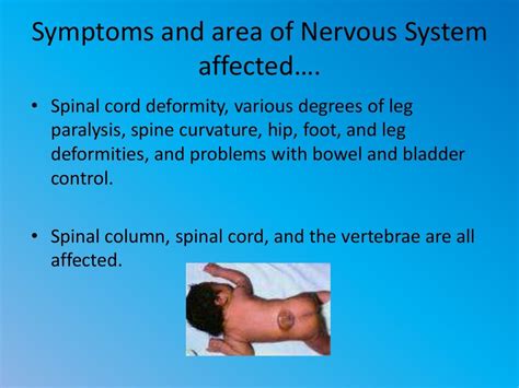Top 3 causes and symptoms of spina bifida