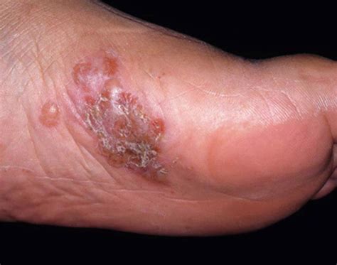 Tinea pedis, athlete's foot, causes, symptoms, diagnosis & treatment