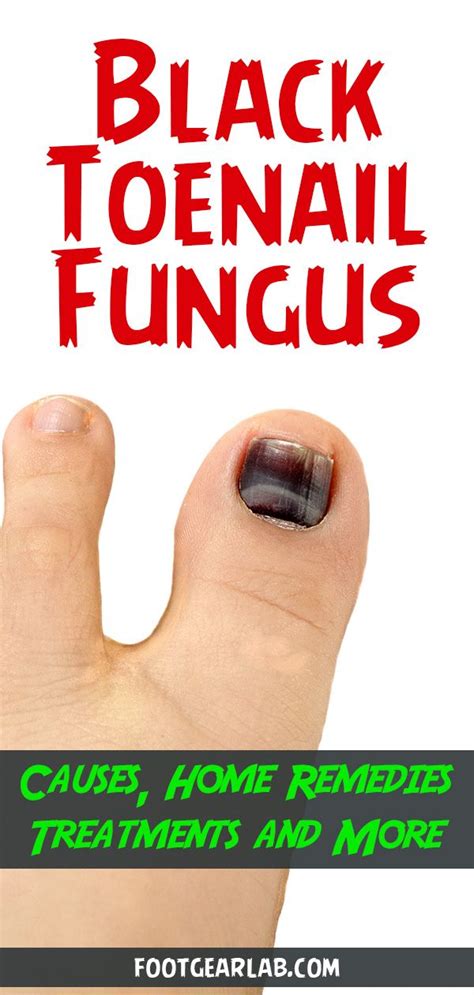 Black Toenail Fungus: Causes, Home Remedies, Treatments And More | Black toenail fungus, Toenail ...