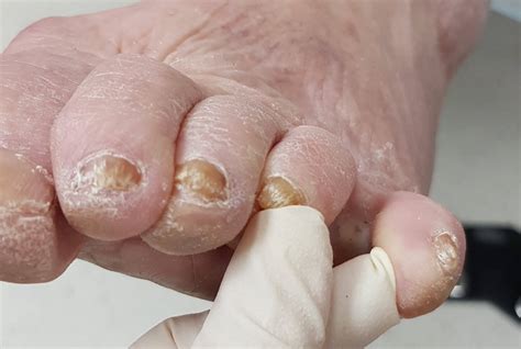 Callous & Corns On Feet: Similarities To Blisters | Blister Prevention