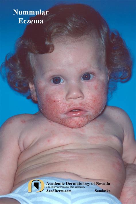 Nummular Eczema - Academic Dermatology of Nevada