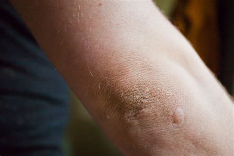 How to Clean Dark Elbows | LIVESTRONG.COM | Dark elbows, Effective skin ...