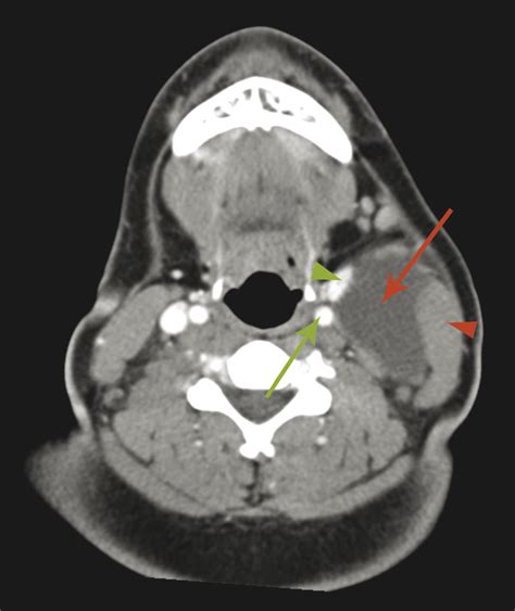 17 Neck Soft Tissue | Radiology Key