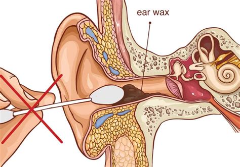 All About Ear Wax Removal | Clear Ears Clinic