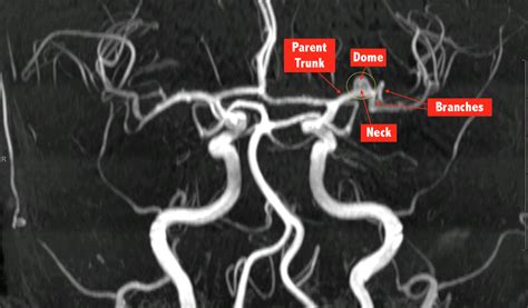 6. MRI-A COW Left MCA aneurysm | C.N.S. Neurosurgery