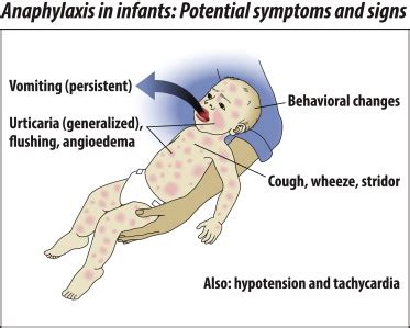 Anaphylaxis: Unique aspects of clinical diagnosis and management in infants (birth to age 2 ...