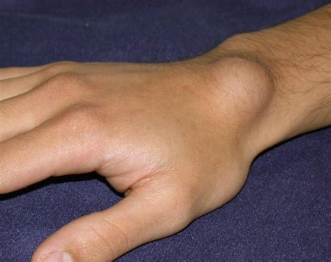 Ganglion Cyst Wrist - Pictures, Treatment, Surgery, Causes, Symptoms