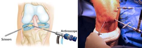 Knee Arthroscopy - OrthoInfo - AAOS