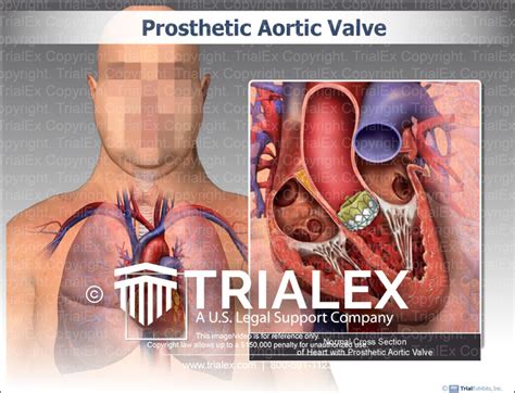 Prosthetic Aortic Valve - TrialQuest Inc.