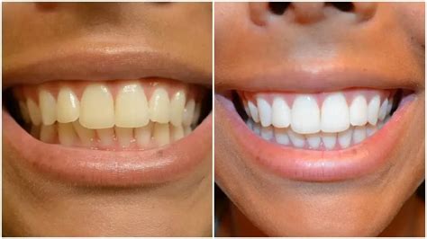 How To Whiten Your Teeth Naturally • Exquisite Magazine - Fashion ...