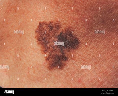 LENTIGO MALIGNA MELANOMA Stock Photo - Alamy