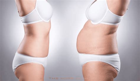 Liposuction Recovery Guide: All You Need to Know - The More Clinics